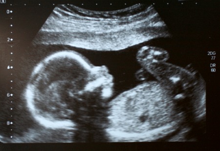 Foetus ultrasound at 22 weeks Feotus ultrasound
